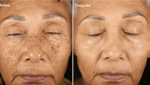 SERUM DE RETINOL - ANTIARRUGAS + REGALO JABON DE CURCUMA PARA EL ACNE