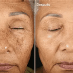 SERUM DE RETINOL - ANTIARRUGAS + REGALO JABON DE CURCUMA PARA EL ACNE